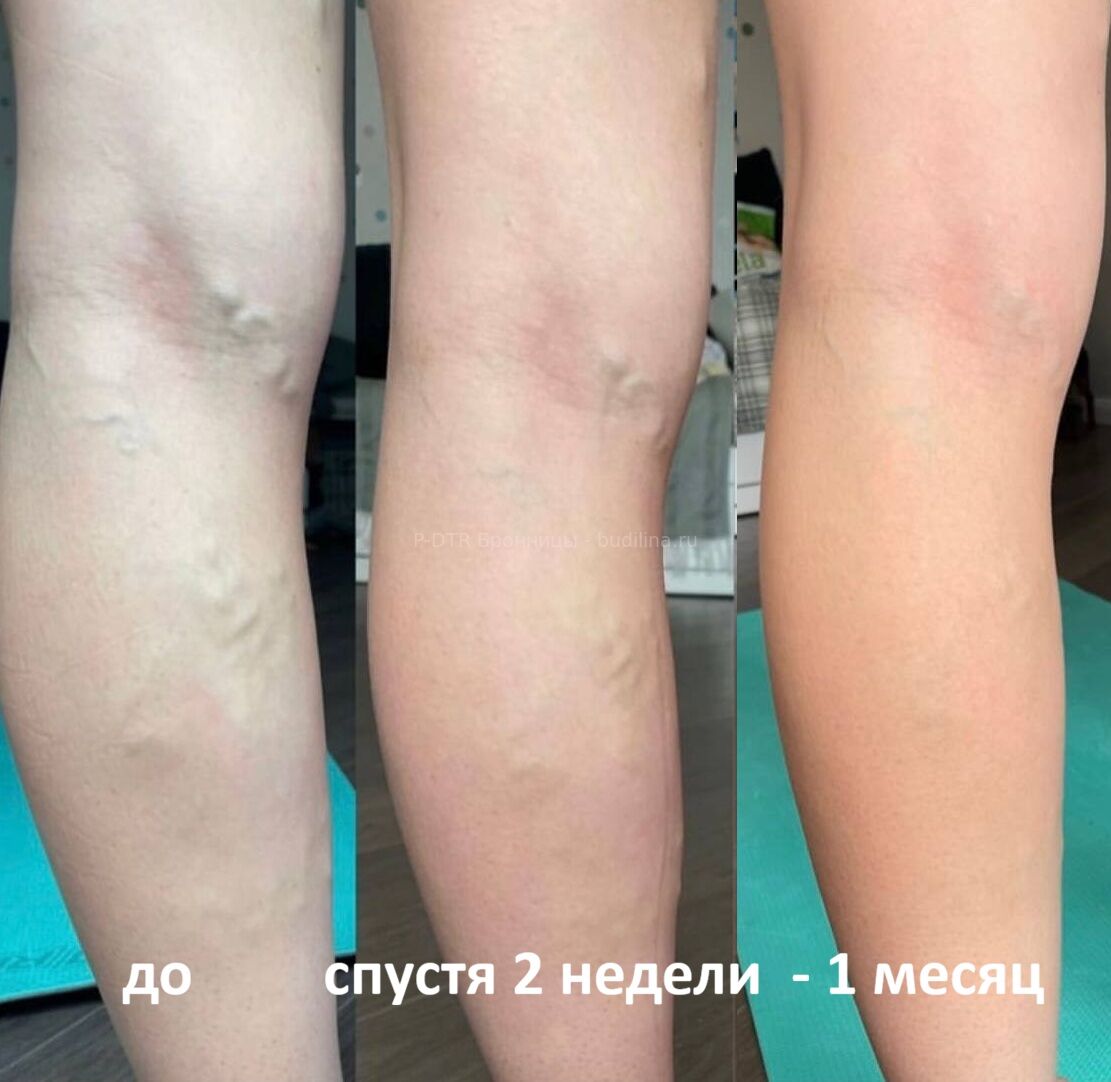 Варикозное расширение вен: результат до и после нейромышечной коррекции P-DTR